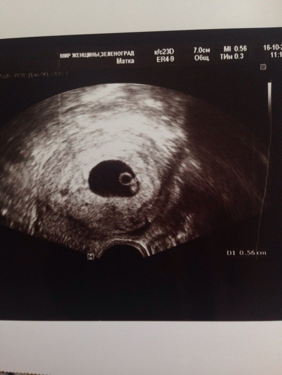 5 акушерская неделя форум. УЗИ эмбриона 6 недель 2 дня. Снимок УЗИ беременности 5-6 недель. УЗИ 6 недель беременности. Как выглядит эмбрион по УЗИ 5-6 недель.