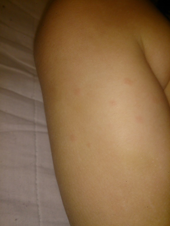 посмотрите плиз прыщи