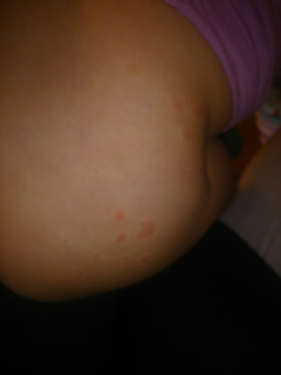 посмотрите плиз прыщи