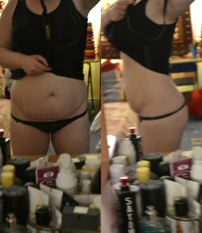 Улыбка на животе, неровность кожи...