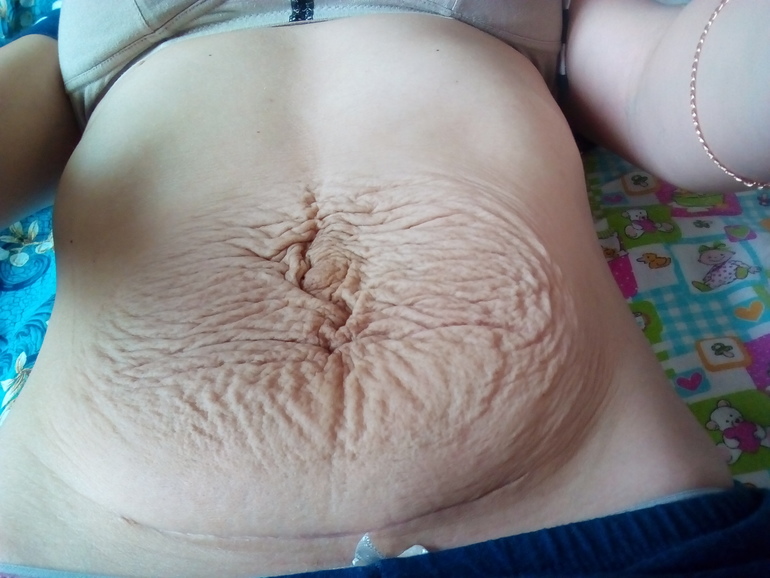 Как избавиться от обвисшей кожи на животе после родов без операции?