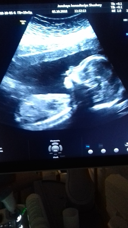 2 ой скрининг. 2 ой скрининг. скрининговое узи беременности. 2 ой скрининг. второй скрининг узи 20 недель.