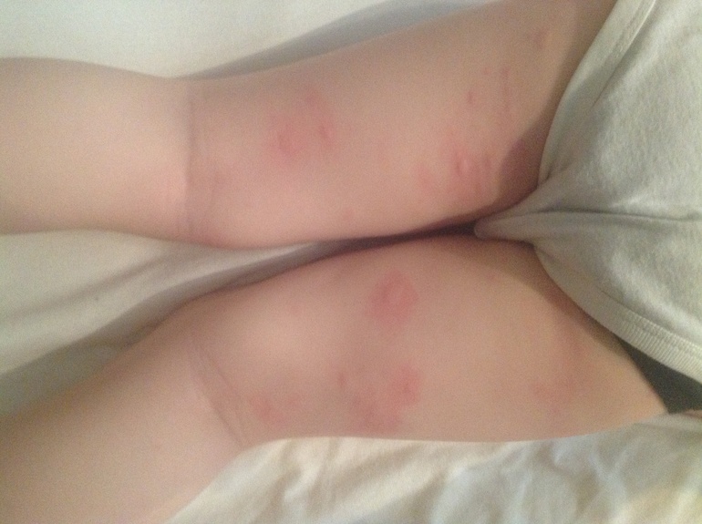 Аллергия????