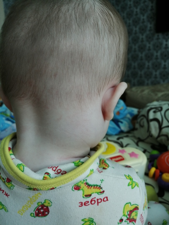 Температура и лимфоузлы на шее у ребенка. Припухлость на затылке у ребенка.