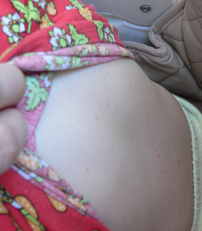 Аллергия или что?