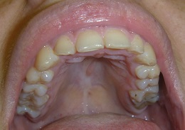 Итог моего ношения брекетов