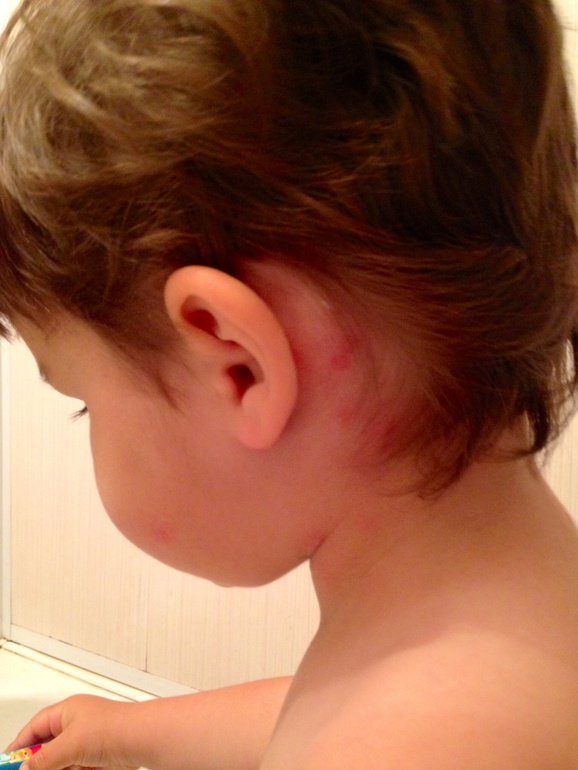 На чьи укусы похоже?