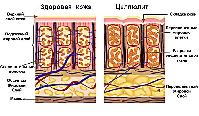 Боремся с целлюлитом