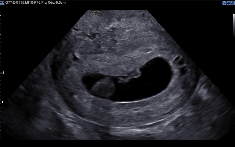 Подсаживали 2 эмбриона. Кружочек в плодном яйце. Ребенок в плодном пузыре фото.