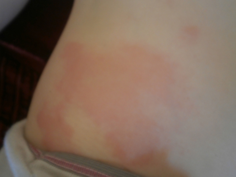 Ночью было нормально а утром вот такие большие пятна