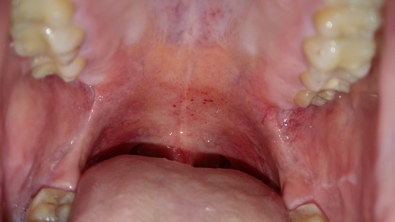 Боль у основания языка после появления красных пятен во рту на нёбе