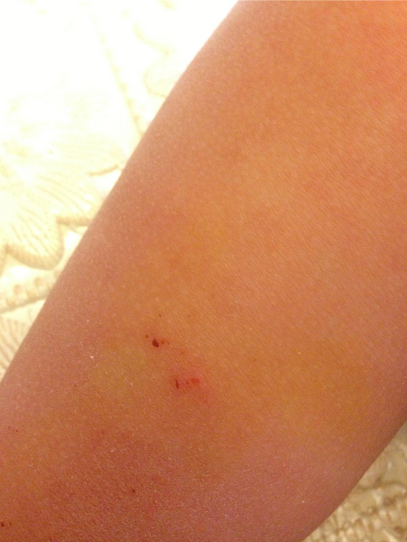 Что за прыщики? Сыпь?