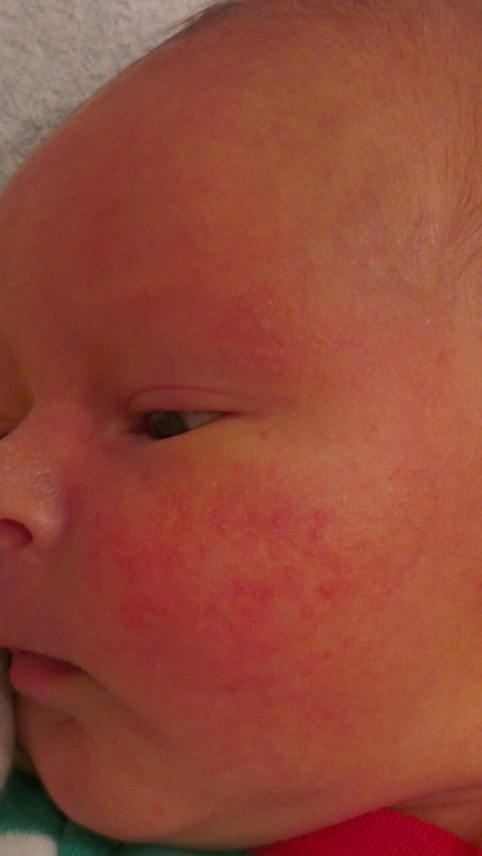 Диатез или что это?