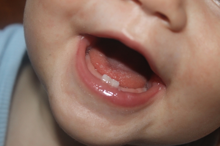 Стоматит или молочница?