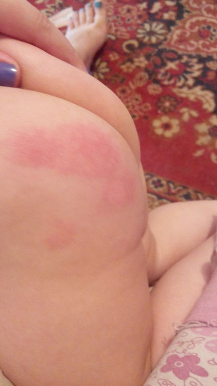 красные пятна на попе!!!