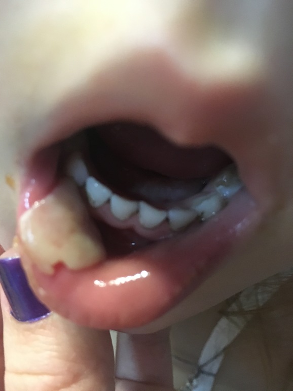 Вашему ребенку удалили зуб | Что важно?