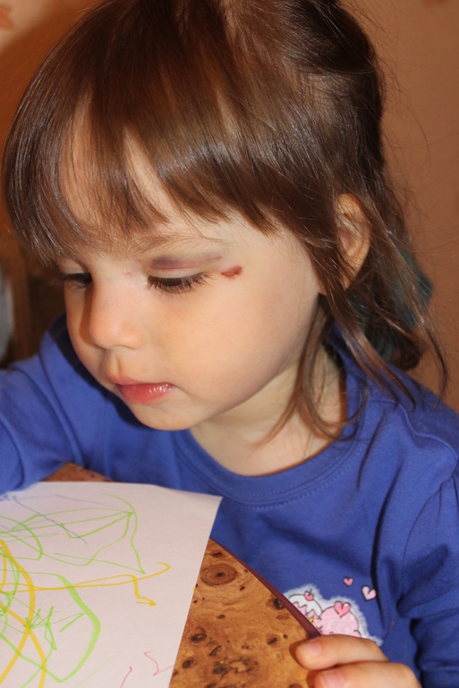 Тупой удар рядом с глазом