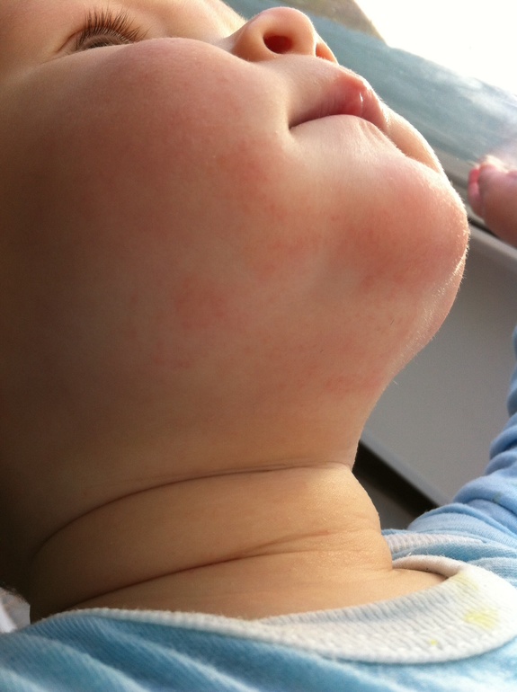 Аллергическая сыпь или слюнявая?