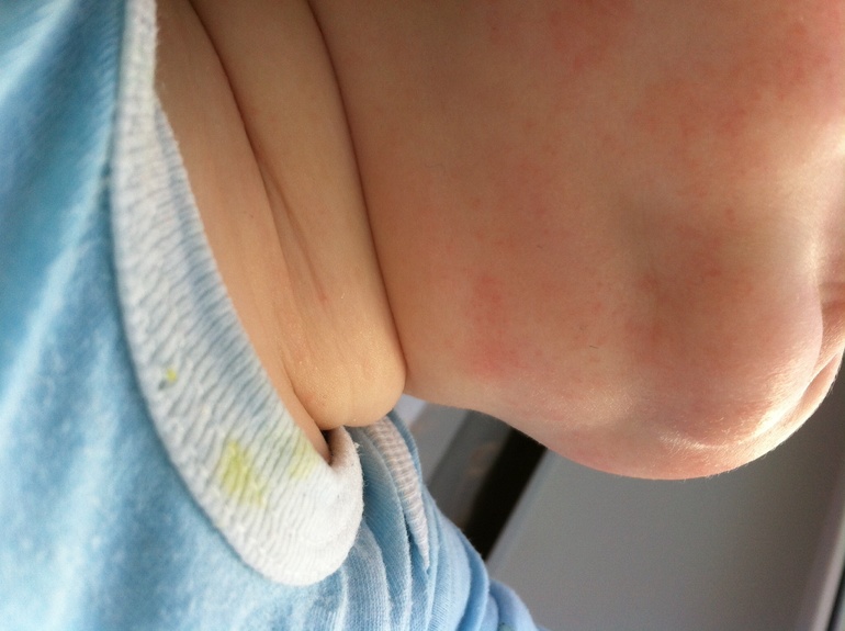 Аллергическая сыпь или слюнявая?