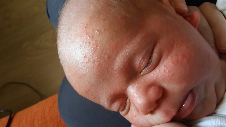 Сыпи у младенцев | Клиника Рассвет