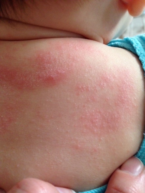 Аллергия или потница? или может еще что?