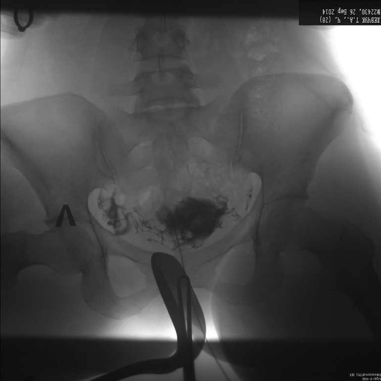 Метросальпингография, посмотрите, неужели все  так плохо?