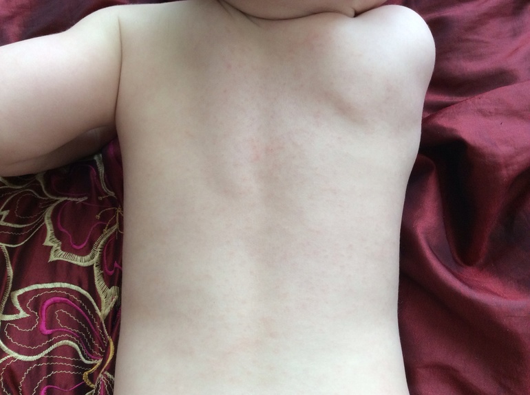 Что за прыщи??