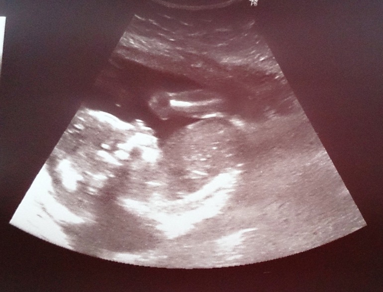 Отчёт о моей беременности с самого начала до 24-й недели