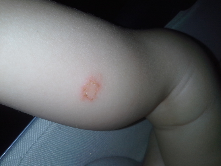 такая вот болячка. аллергия или что-то другое?