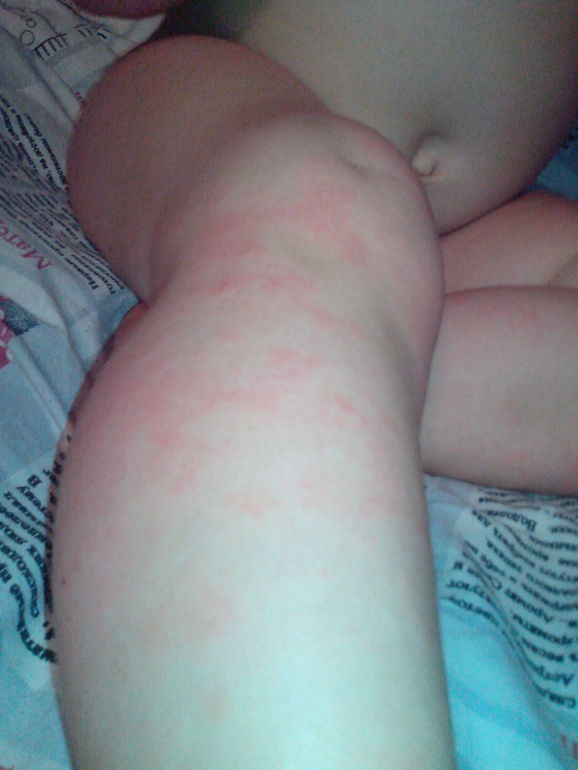 лечим уже 3 месяца