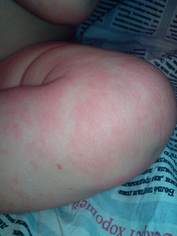 лечим уже 3 месяца