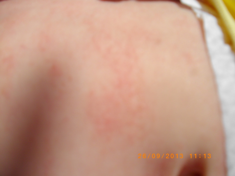 Сыпь....Может кто то знает что это такое, оно еще и шелушится....